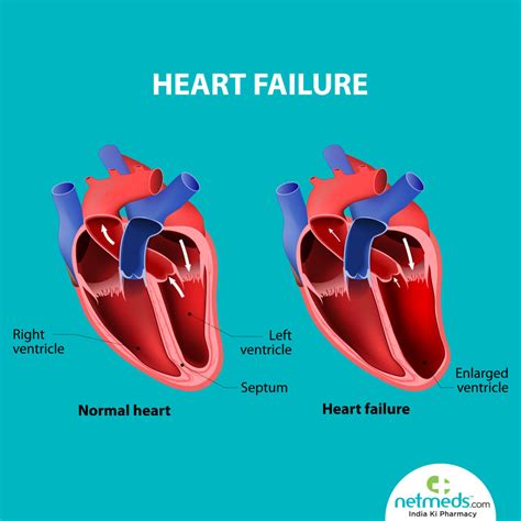 lv systolic dysfunction|lv systolic dysfunction treatment.